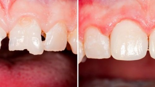 Эстетическая реставрация: восстановление идеальной формы зубов
