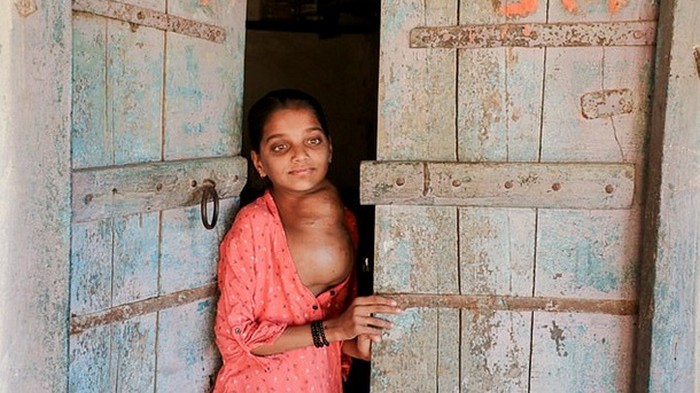 В Индии у 12-летней девочки выросла вторая голова на шее (фото)