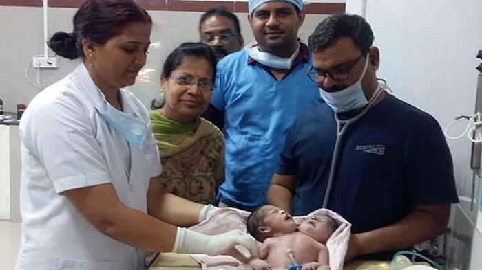 В Индии родился двухголовый и трехрукий ребенок (фото)