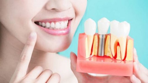 Современные технологии имплантации зубов