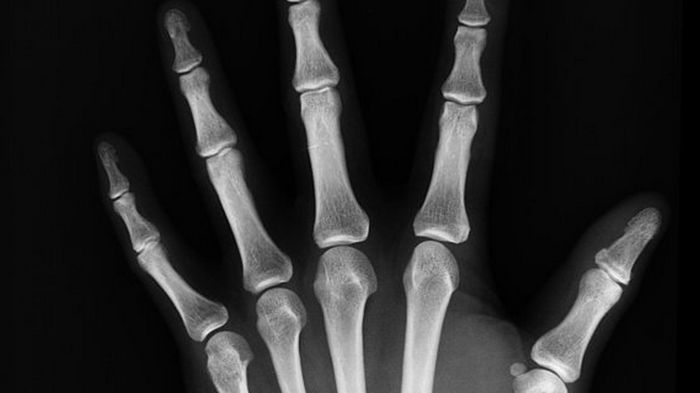 Американцы научились быстрее восстанавливать повреждения костей