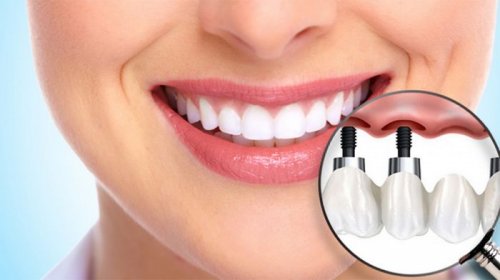 Имплантация зубов: особенности технологии