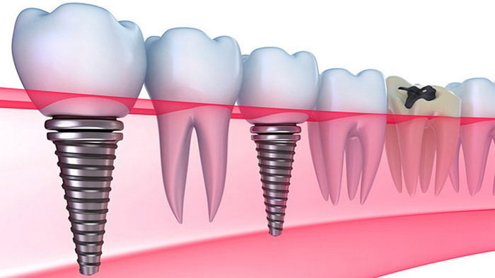 Имплантация зубов в Днепре: какая от этого польза