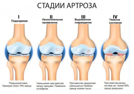 стадии артроза коленного сустава