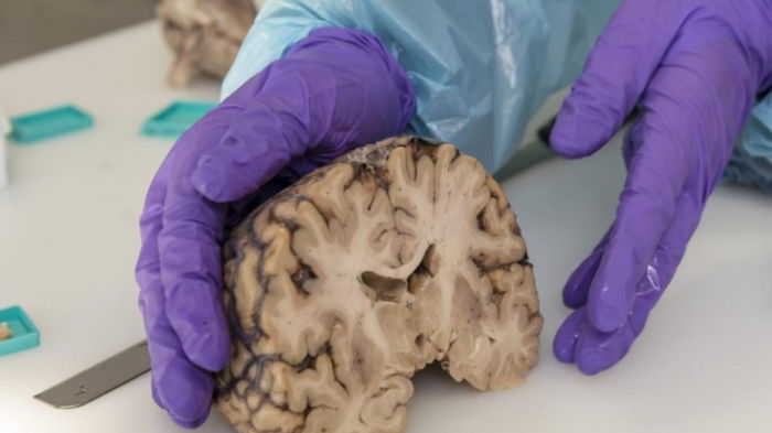 Ученые обнаружили «зомби гены», увеличивающие активность в мозге после смерти