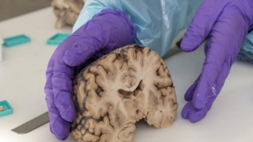 Ученые обнаружили «зомби гены», увеличивающие активность в мозге после...