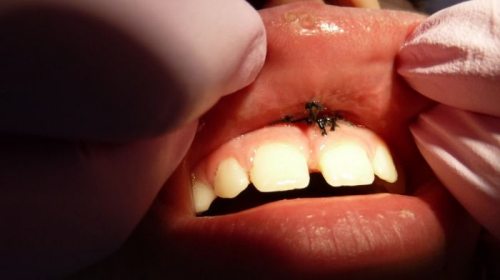 Пластика уздечки верхней губы и языка: показания и методы