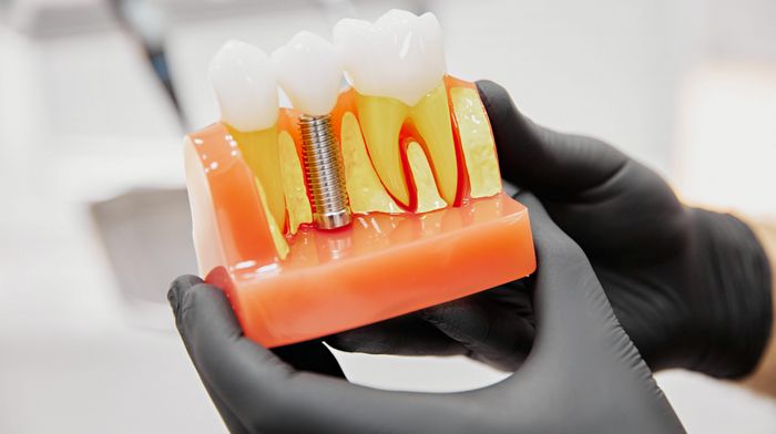 Когда должна проводиться имплантация зубов в Днепре?