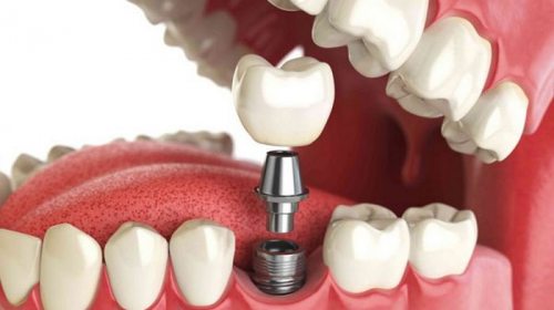 Когда должна проводиться имплантация зубов в Днепре?