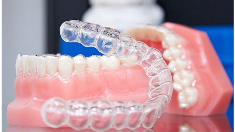 Капы для выравнивания зубов: современные решения от ортодонтов
