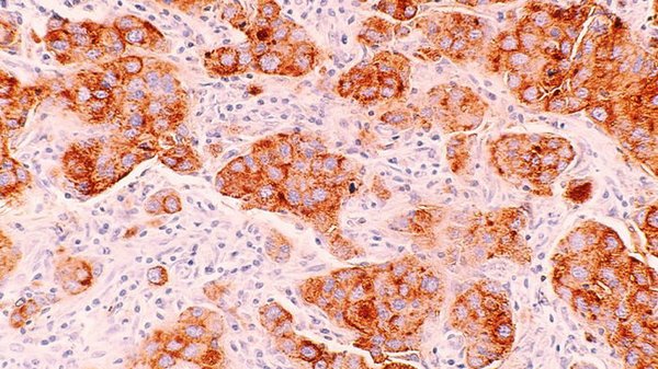 Удалось уничтожить 99% раковых клеток: ученые испытали новый метод лечения болезни