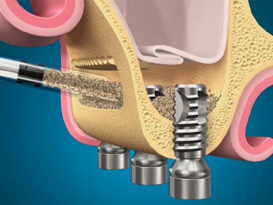 Зачем нужна операция синус-лифтинг при протезировании зубов?