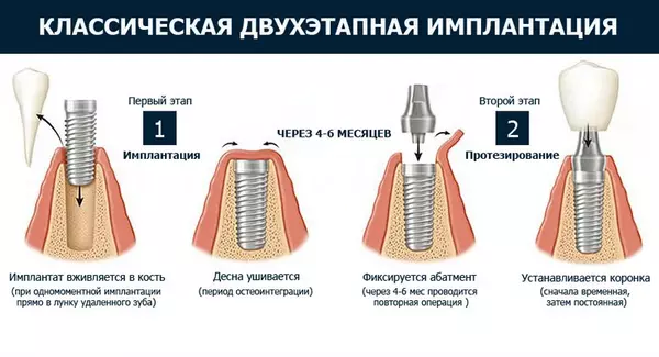 классическая имплантация зубов