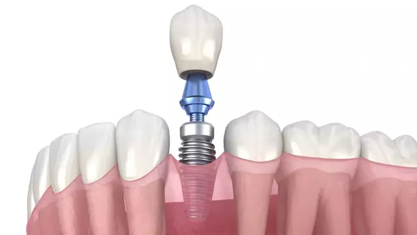 Все этапы имплантации зубов: пошаговый гайд по процедуре
