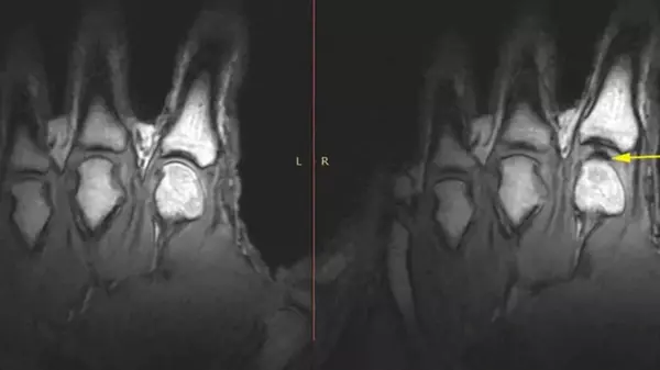 Фейерверки в суставах: что на самом деле происходит с пальцами, когда ими хрустят (видео)