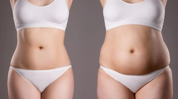 Абдоминопластика: талия без усилий