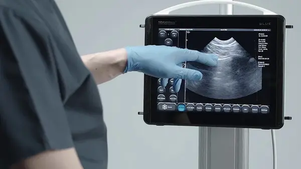 УЗД легень — сучасна діагностика без променевого навантаження