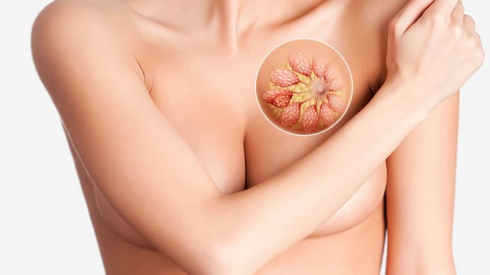 Як сьогодні лікують мастопатію?