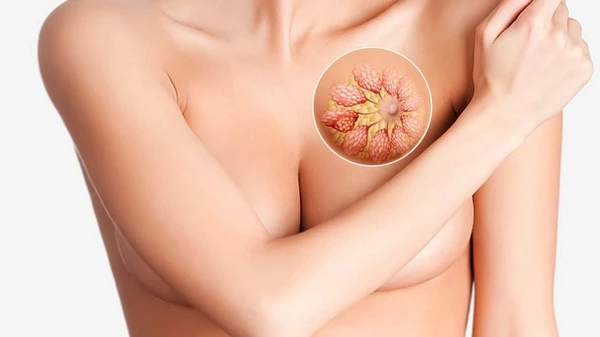 Як сьогодні лікують мастопатію?