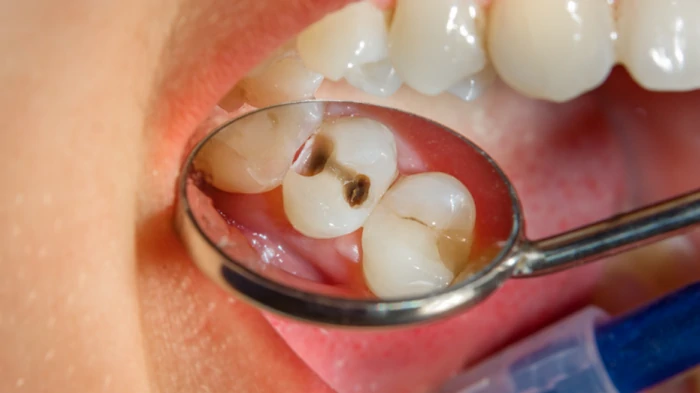 Лечение кариеса и реставрация зубов Лечение кариеса и реставрация зубов