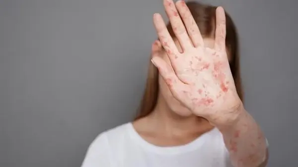 Заболеваемость корью в Украине выросла в десять раз