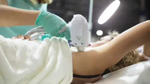 Діодний лазер і апарат лазерної епіляції: від технології до прибуткового бізнес-інструменту