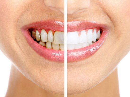 Как избавится от зубного налета в стоматологической клинике